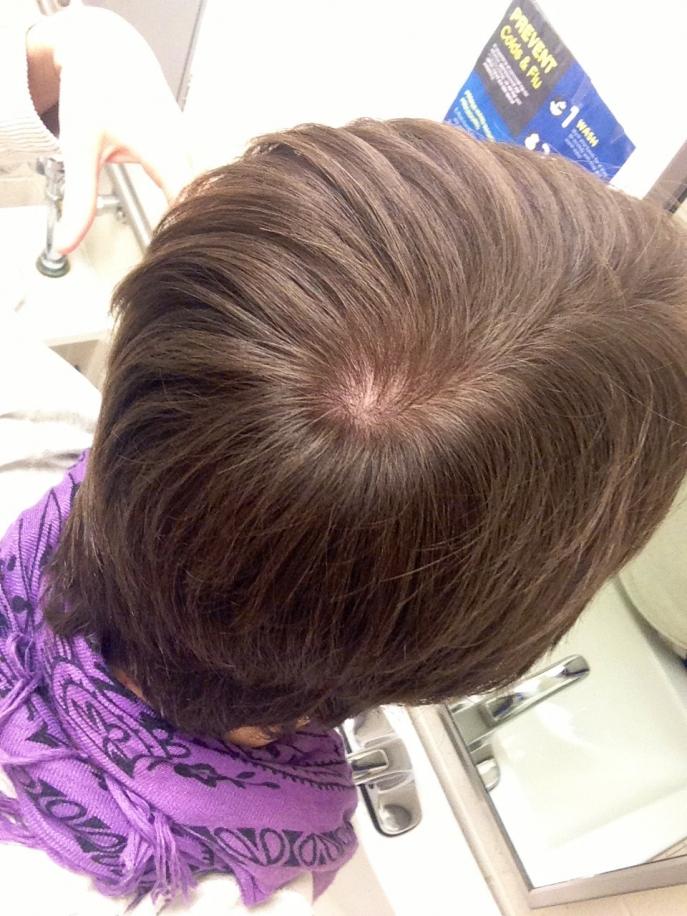 Is My Crown Thinning Baldtruthtalk Com