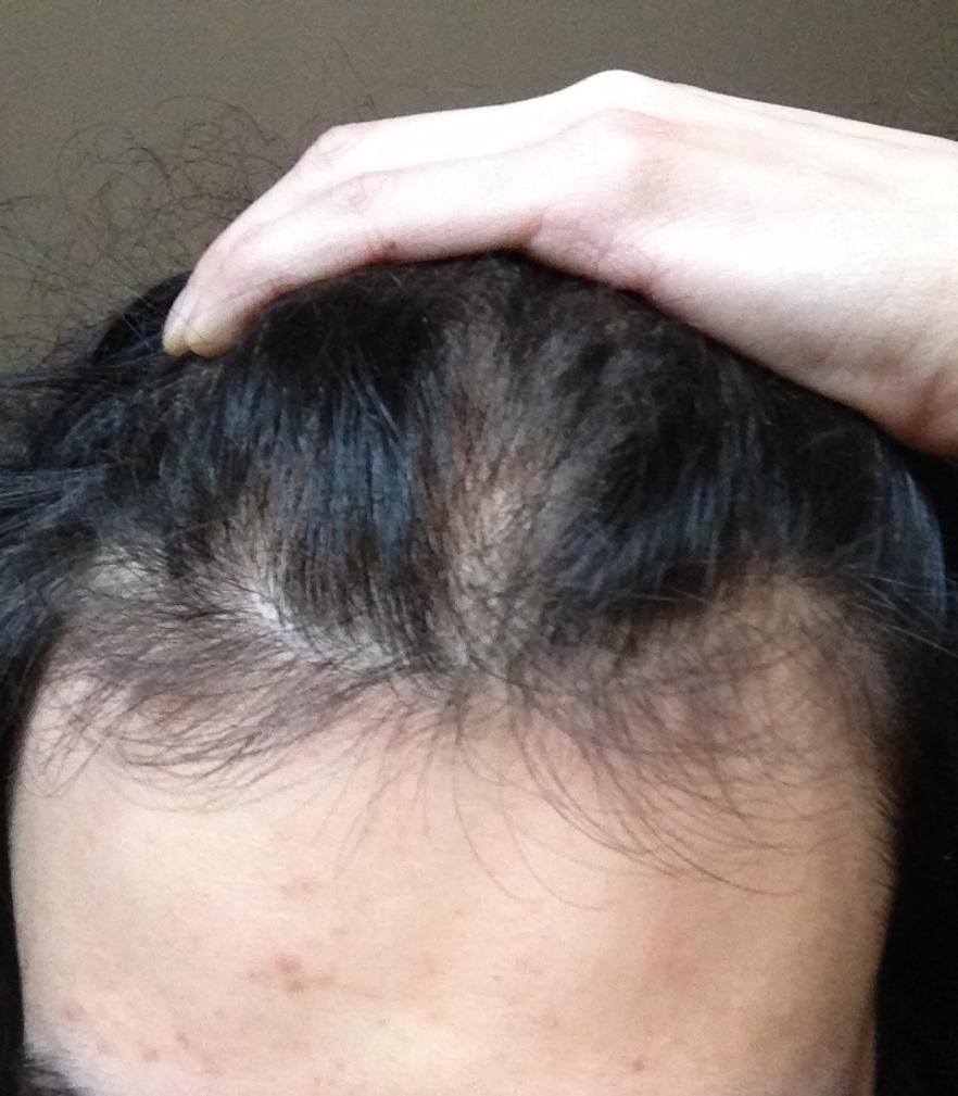 Im A 19 Year Old Guy With Female Pattern Baldness Does It Have