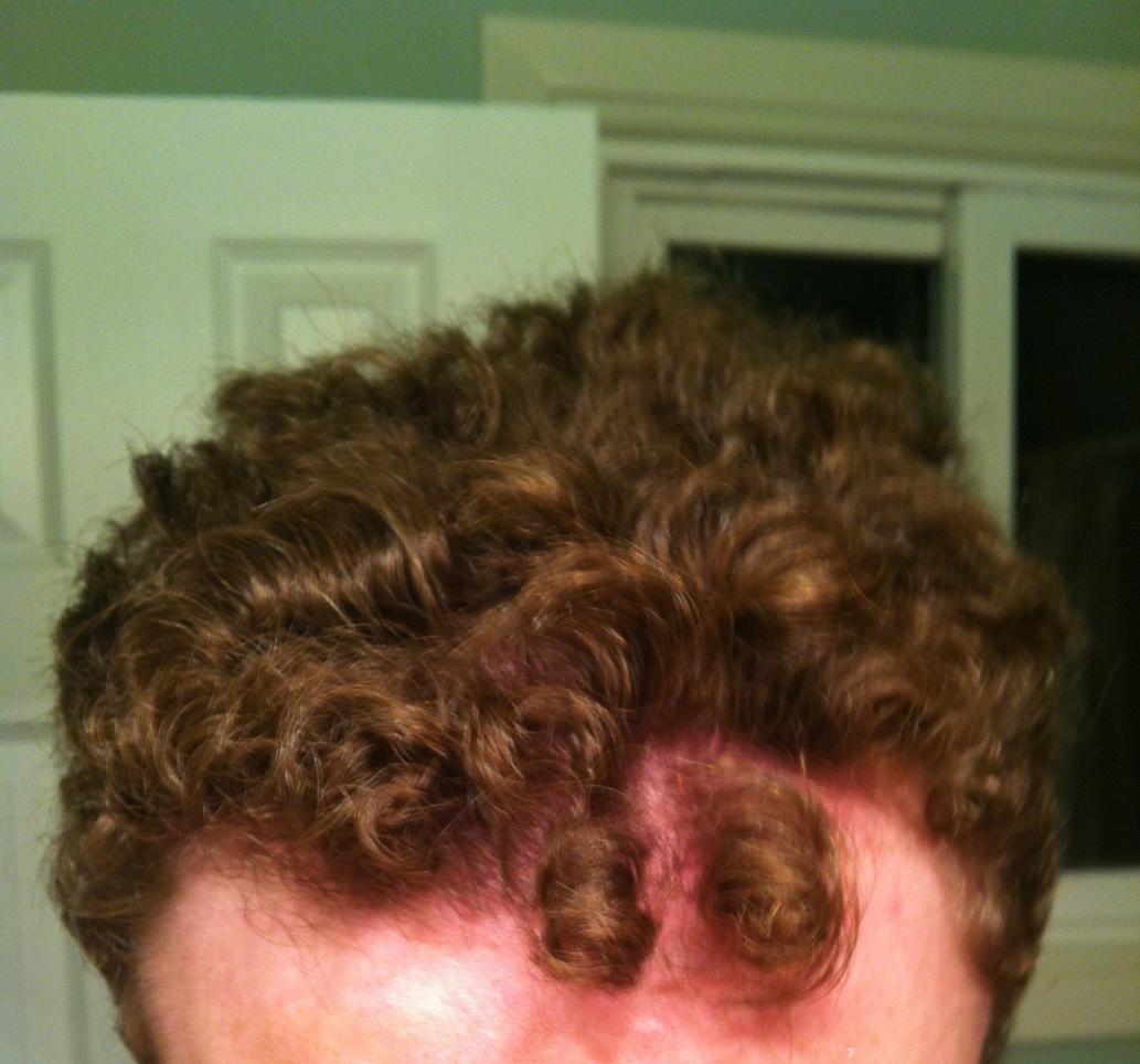 I Know Thinning More On One Side Is Normal But This Is Ridicules