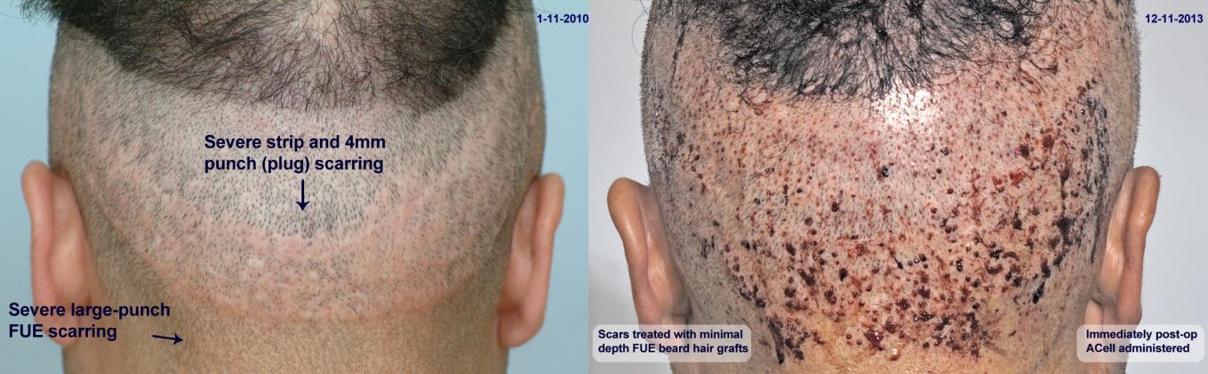 Click image for larger version

Name:	side-by-side-scar.jpg

Size:	110.6 KB
ID:	24351