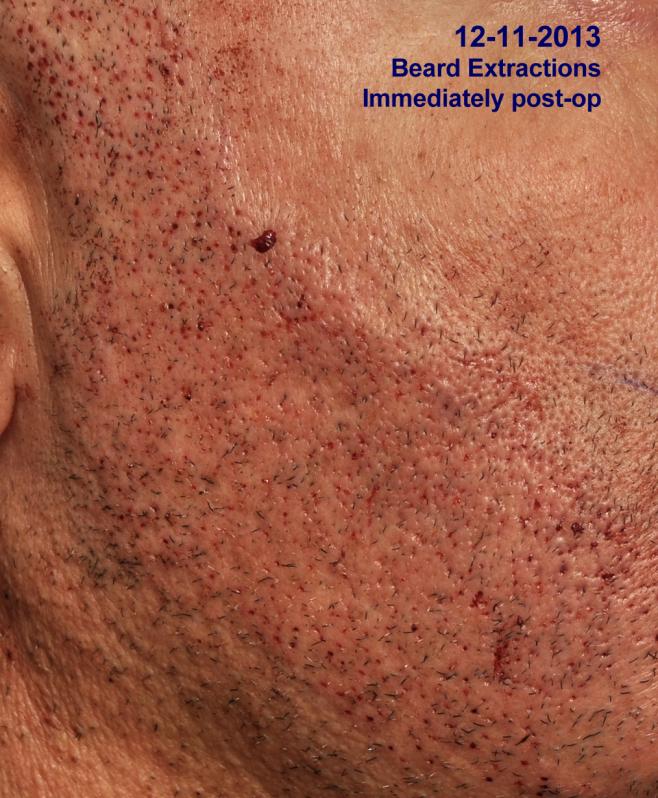 Click image for larger version

Name:	beard-extractions.jpg

Size:	95.8 KB
ID:	24352
