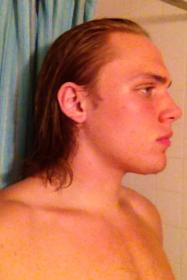 18 Year Old Possible Early Stage Of Mpb Baldtruthtalk Com