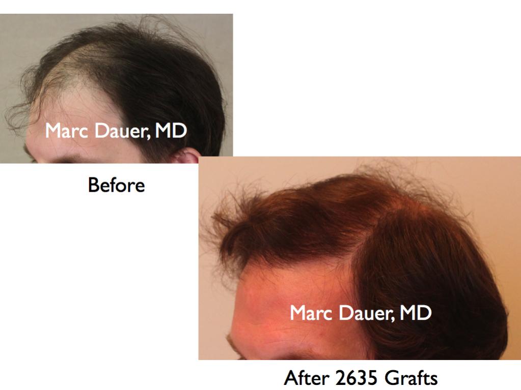 Click image for larger version

Name:	Hair Transplant Slides3.150.jpg

Size:	54.5 KB
ID:	25938