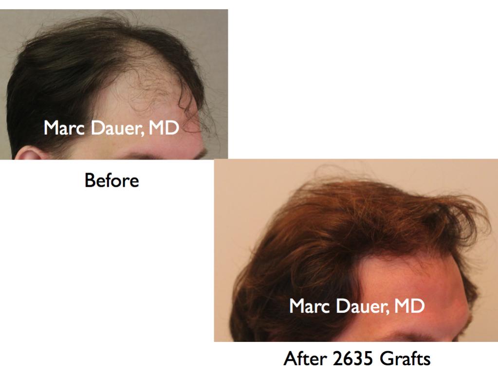 Click image for larger version

Name:	Hair Transplant Slides3.151.jpg

Size:	51.5 KB
ID:	25939