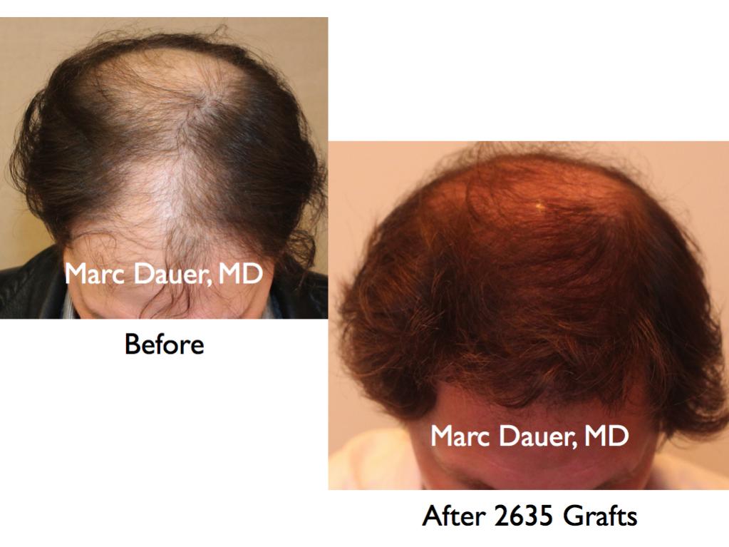 Click image for larger version

Name:	Hair Transplant Slides3.152.jpg

Size:	66.7 KB
ID:	25940