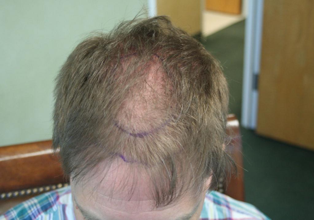 Diffuse Thinning Through Out The Top Baldtruthtalk Com