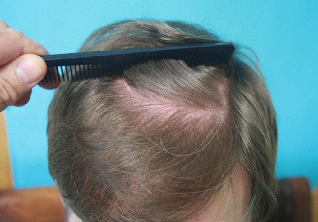 Diffuse Thinning Through Out The Top Baldtruthtalk Com