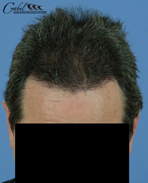 Dr. Gabel - 3073 Grafts Before & Afters