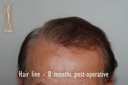 Image uploaded by: Dr Feriduni Hair Clinic