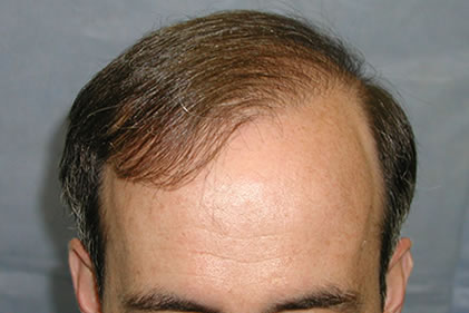 Results After One Session

View his full photoset >> http://www.bernsteinmedical.com/hair-transplant-photos/portraits/patient-qpc/