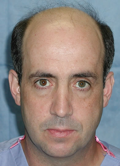 Patient QPC before hair transplant

View his full photoset >> http://www.bernsteinmedical.com/hair-transplant-photos/portraits/patient-qpc/