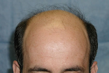 Patient QPC before hair transplant

View his full photoset >> http://www.bernsteinmedical.com/hair-transplant-photos/portraits/patient-qpc/