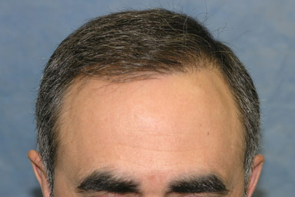 Patient CSZ's hairline after one procedure

View his full photoset >> http://www.bernsteinmedical.com/hair-transplant-photos/portraits/patient-csz/