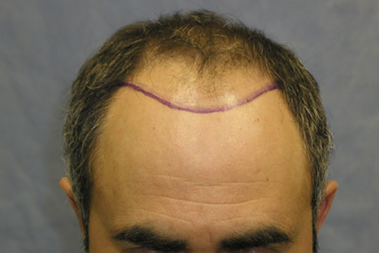 Position of hairline

View his full photoset >> http://www.bernsteinmedical.com/hair-transplant-photos/portraits/patient-csz/