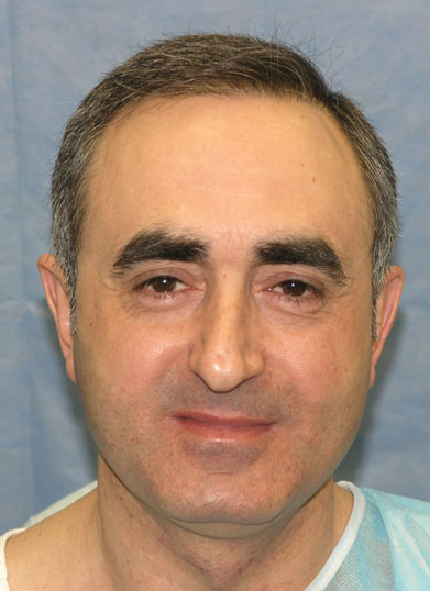 Patient CSZ after hair transplant

View his full photoset >> http://www.bernsteinmedical.com/hair-transplant-photos/portraits/patient-csz/