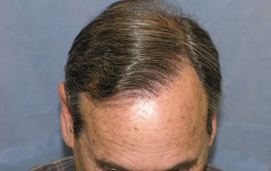 Top of Head and Hair Line After Second Session

View his full photoset >> http://www.bernsteinmedical.com/hair-transplant-photos/portraits/patient-fzi/