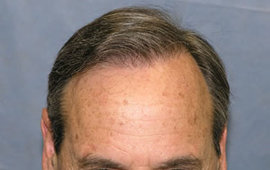 Detail of Hair Line After Second Session

View his full photoset >> http://www.bernsteinmedical.com/hair-transplant-photos/portraits/patient-fzi/
