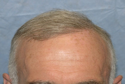 Patient BHZ 14 mos After
 
View his full photoset >> http://www.bernsteinmedical.com/hair-transplant-photos/portraits/patient-bhz/