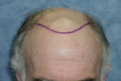 Patient BHZ planned hairline
 
View his full photoset >> http://www.bernsteinmedical.com/hair-transplant-photos/portraits/patient-bhz/