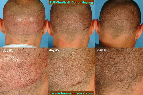This is an updated photo to reflect the status of the donor area at post-op day #8. This FUE hair transplant was performed with the NeoGraft machine at Bauman Medical Group.