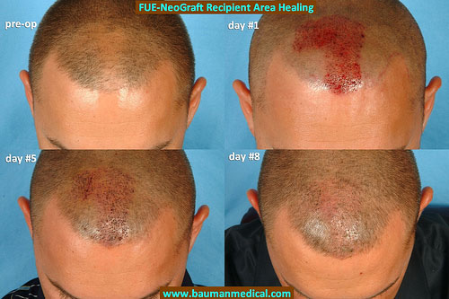 This is an updated photo to reflect the status of the recipient area at post-op day #8. Please note that although the transplanted area appears 'full,' it is expected that the transplanted hairs will shed within the next few days and then begin to regrow within 6-12 weeks. Half of the result should be visible at 6 months, full results in 12 months. This FUE hair transplant was performed with the NeoGraft machine at Bauman Medical Group.