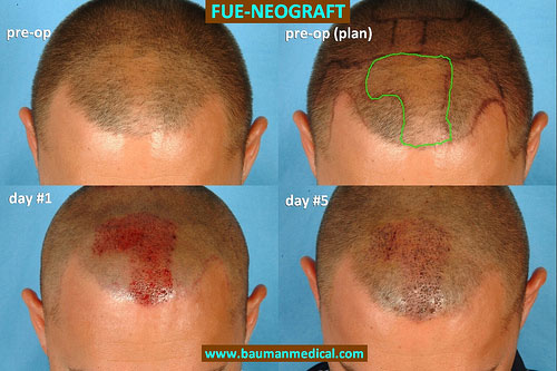 The recipient area of a hair transplant procedure is the thinning area where the follicles are transplanted to. The Neograft device assists with implantation throught the use of dual mechanical implanters which use suction and positive air pressure to gently place the grafts into the sites the surgeon has created--without the use of forceps. For this patient, we transplanted 1603 grafts into the recipient areas. All grafts were placed into sites that were 1mm in size or less. Hair growth typically begins around 6 weeks, with improvements in coverage occurring from 4 to 6 months, full result in 12 months. For more info on Neograft or Bauman Medical Group, visit www.baumanmedical.com