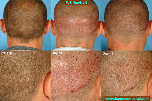The major advantage of any FUE procedure is the lack of a linear scar. The tiny 0.8mm harvest sites close 50% in size within 24 hours and can be completely undetectable within a weeks time, depending on the quality of hair in the donor area. Eventually, when the surrounding hair reaches a certain length (approximately 8mm) the area is completely camouflaged. Patients have less discomfort and can return to vigorous physical activity much sooner with FUE/Neograft procedures. Bauman Medical Group is one of the first medical offices in the U.S. and the only office in Florida to have the Neograft device. Stay tuned for more photos of this patient as his donor area continues to heal and camouflage improves further.