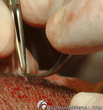 Careful extraction of an FUE graft during an hair transplant procedure. The initial incision was made with a 0.8mm Neograft device.