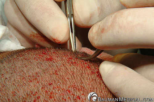 This shows the manual extraction of an FUE graft during transplantation. A very specific, gentle approach is used to remove the graft from the skin without trauma to the follicle.