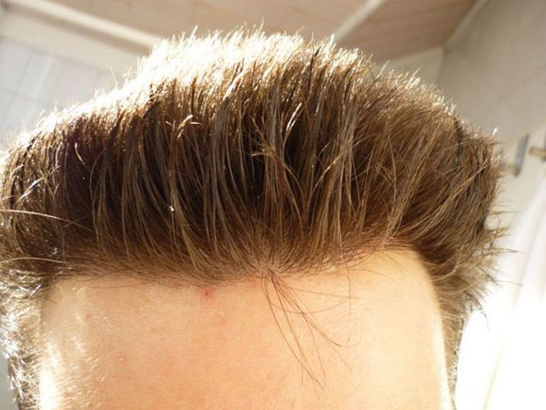 Image uploaded by: Rahal Hair Transplant