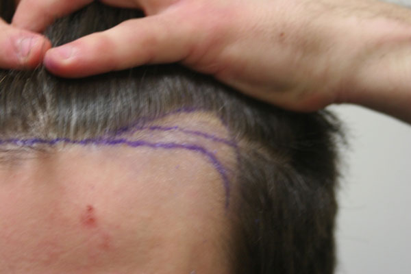 Image uploaded by: Rahal Hair Transplant