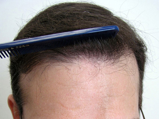 Hairline closeup after 3511 follicular units