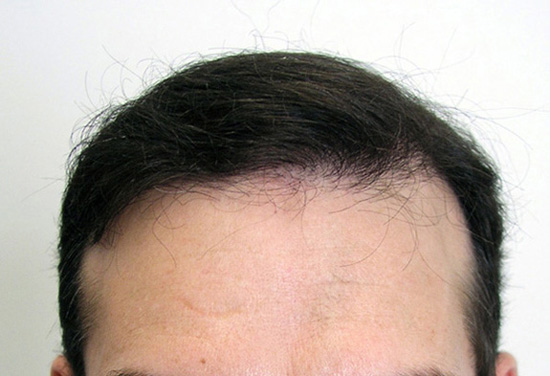 After 3511 follicular units by Dr. Dorin