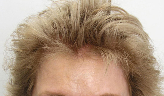 Female hairline restoration