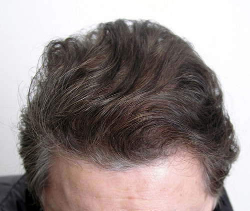 After 1 FUT:  2012 follicular units