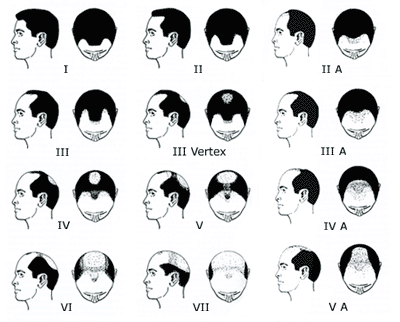 Norwood Scale - Male Pattern Baldness