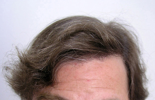 RESULT AFTER ONE FUT OF 1630 FOLLICULAR UNITS
