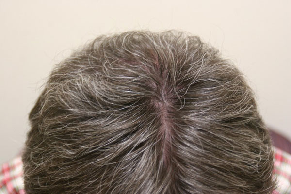 Image uploaded by: Rahal Hair Transplant