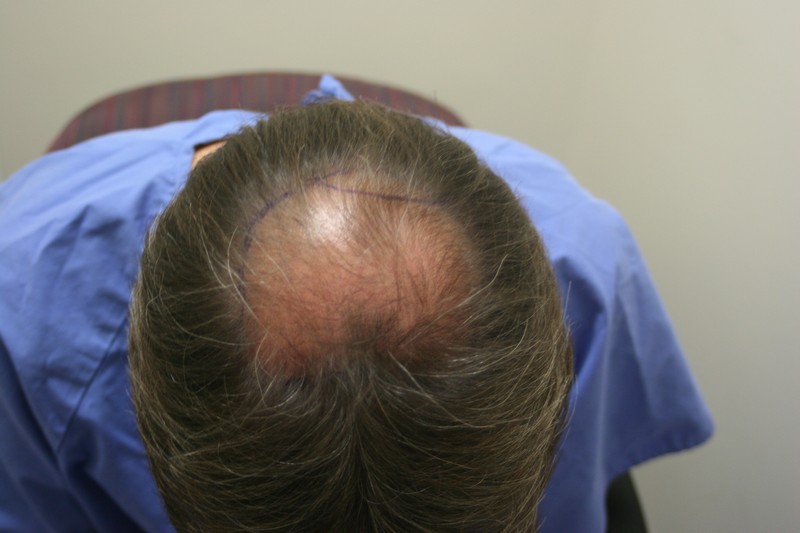 Image uploaded by: Rahal Hair Transplant