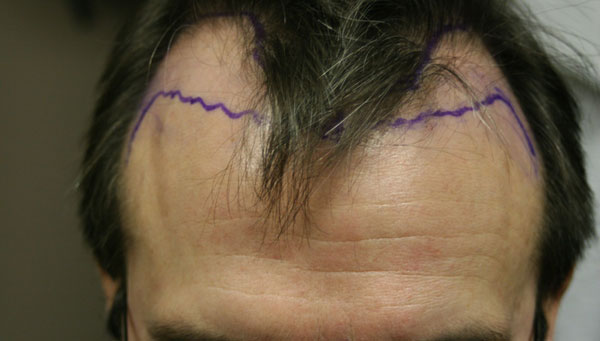 Image uploaded by: Rahal Hair Transplant