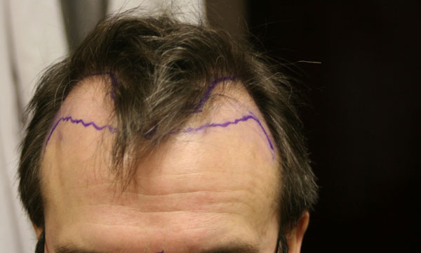 Image uploaded by: Rahal Hair Transplant