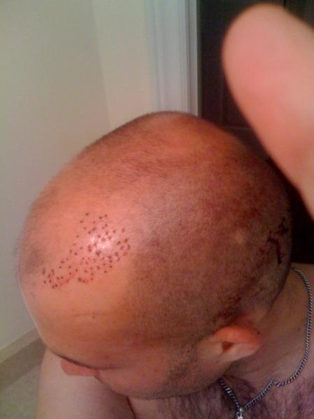 Hairline snapshot after the graft removal procedure (090709)