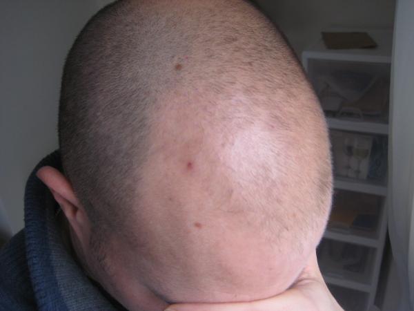 Result after 2 short procedures to remove hairline grafts.  Notice no visible scarring.  There are a few grafts left (its hard to get them all in one session as some tend to break as they are pulled out).  After one more operation we should have them all out!  
(091207)