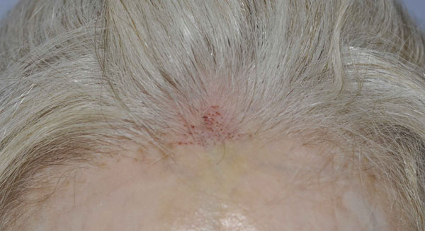 133 Graft FUE