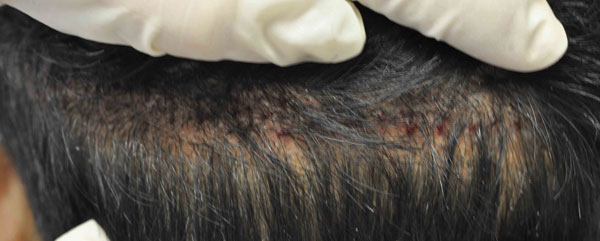 Scar Revision