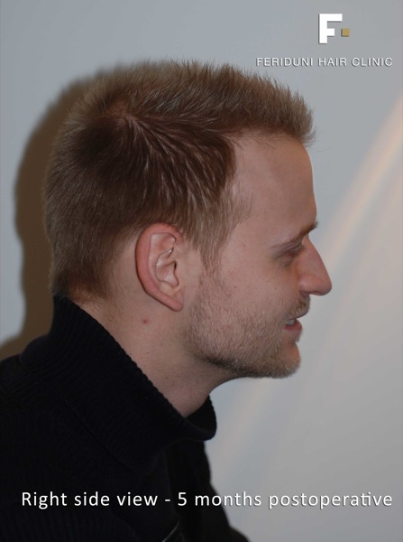 Image uploaded by: Dr Feriduni Hair Clinic