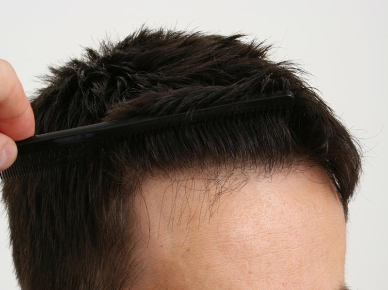 Hairline view after 1156 follicular units