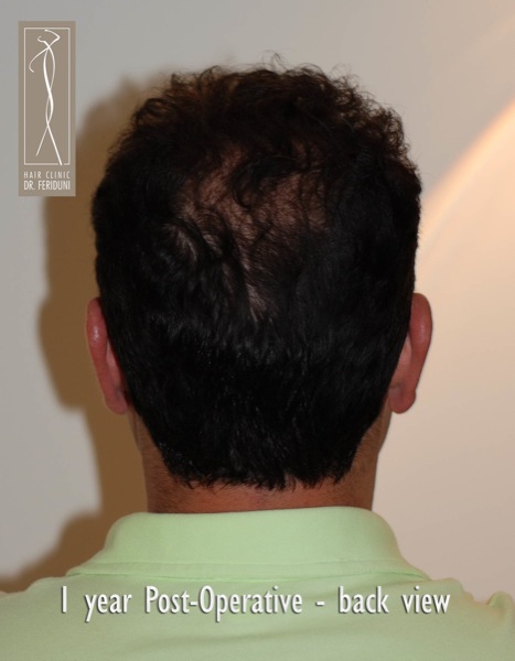 Image uploaded by: Dr Feriduni Hair Clinic