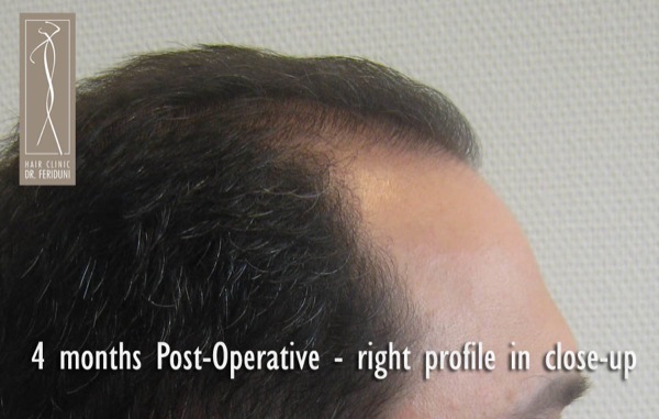 Image uploaded by: Dr Feriduni Hair Clinic