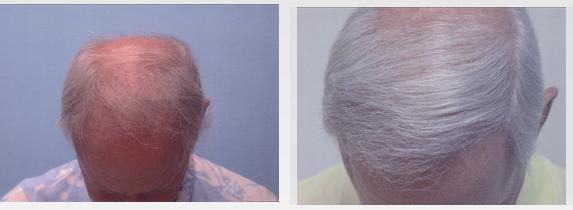 Before and after hair transplant procedure